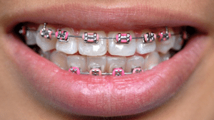 Clear Braces for Teens: The Pros and Cons of Ceramic Braces, Lower  Mainland BC