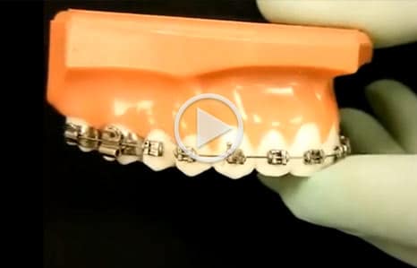 Orthodontic Emergencies - Boss Orthodontics